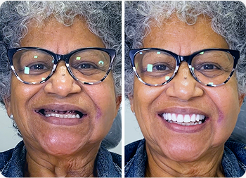 Protocolo de Carga Imediata