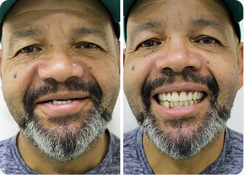 Protocolo de Carga Imediata